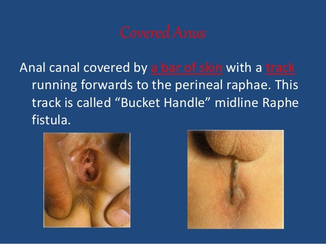 Ectopic anal canal pic 140